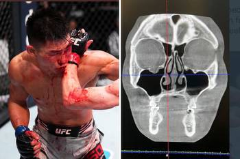 UFC star Song Yadong reveals X-Ray of fractured orbital that needs titanium plate after seeing 'triple' during bout